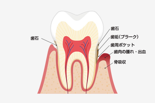 歯周病とは 赤穗市の歯医者はさくらファミリー歯科へ イオン赤穂店2fの歯科医院